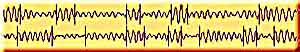 EEG filtered in alpha band, with change-points