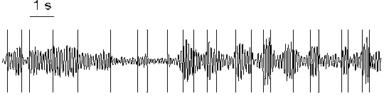 Change-points in EEG components with different pattern